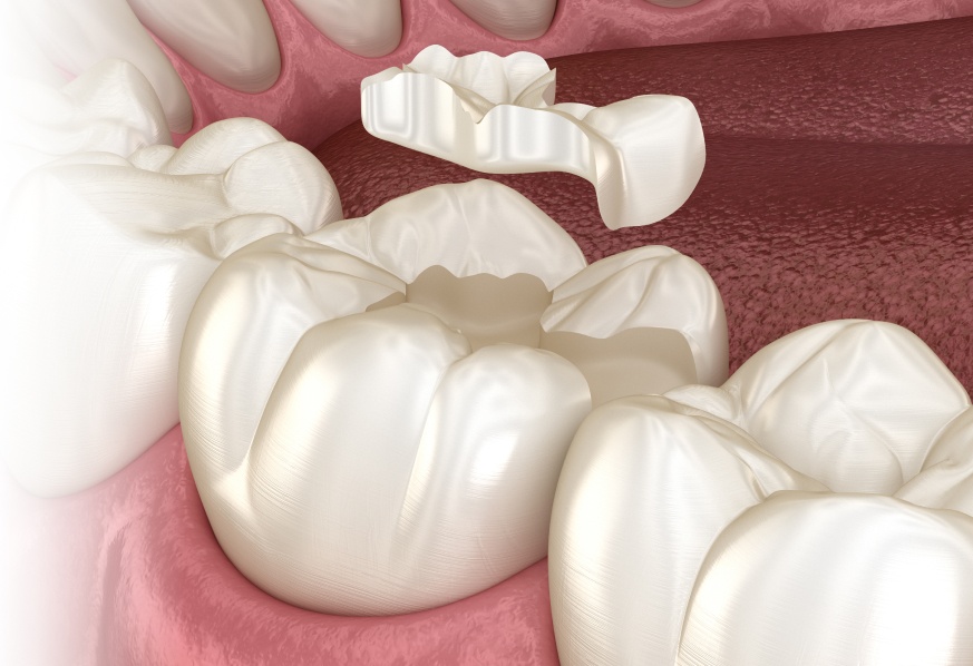 veneer